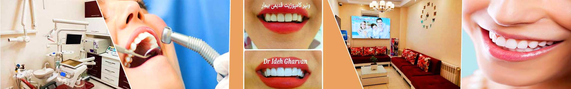 بهترین خرید دندانپزشکی قروان تهران با بیشترین درصد تخفیف در قیمت - 83%